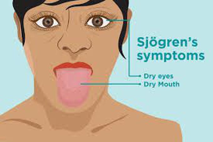 Sjogrens syndrome