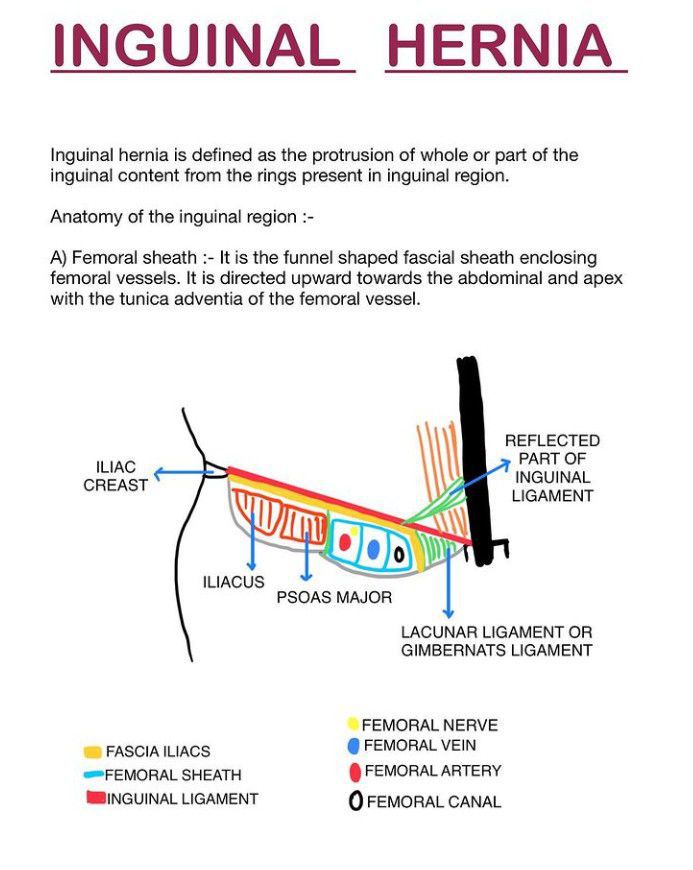 Femoral hernia - MEDizzy