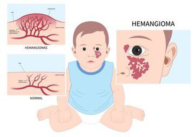 Cause of Hemangioma