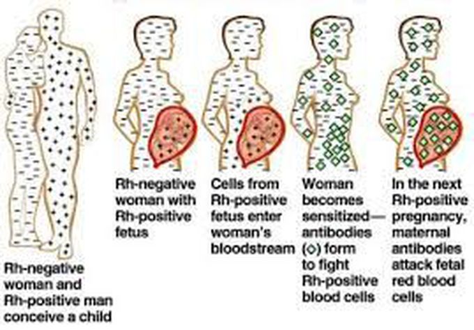 Erythroblastosis fetalis