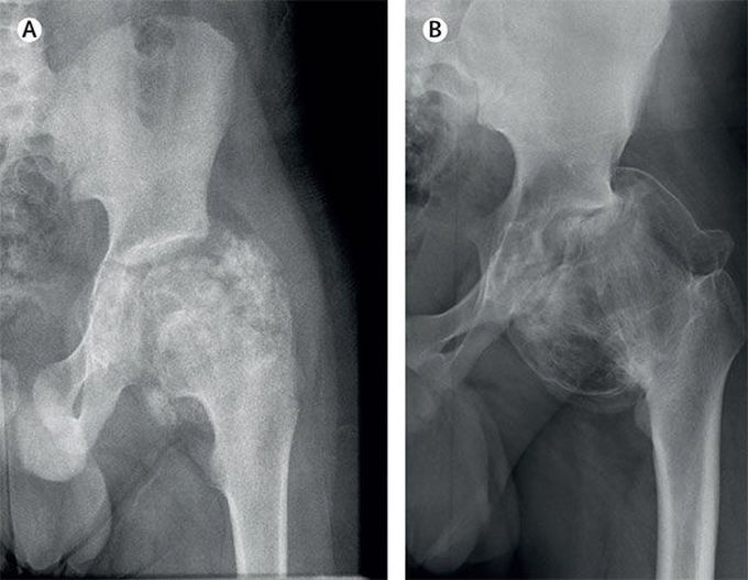 Chronic hip pain in a child