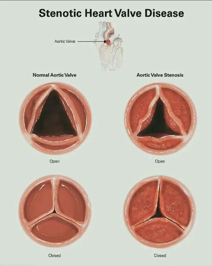 Stenotic Heart valve