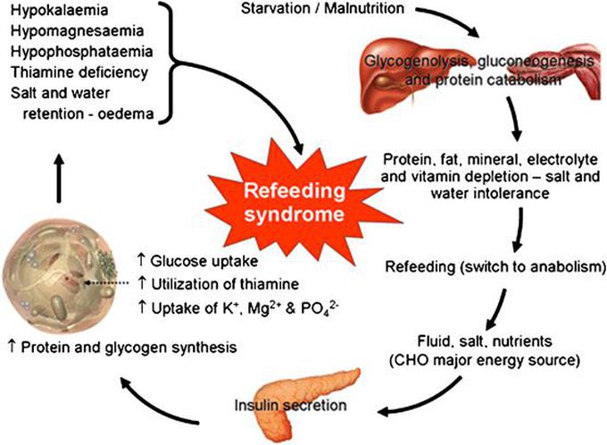 Refeeding syndrome