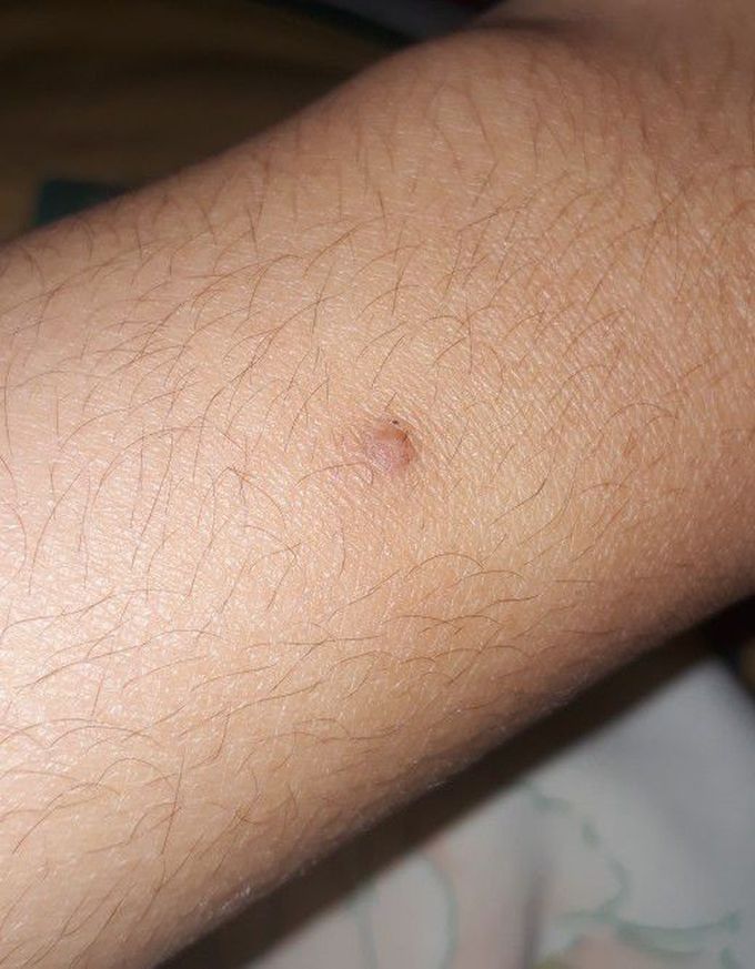 A Pimple on arm for more than a month. What do you think it is?