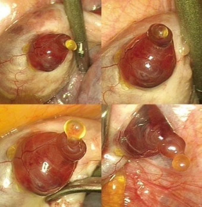 Ovulation