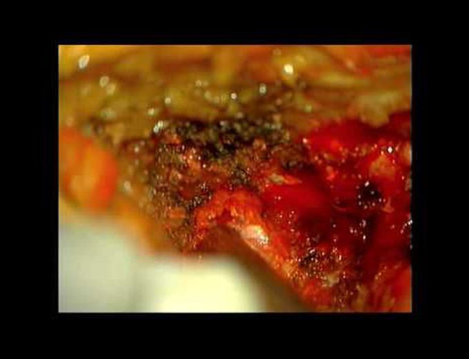 Minimally invasive transforaminal lumbosacral interbody fusion