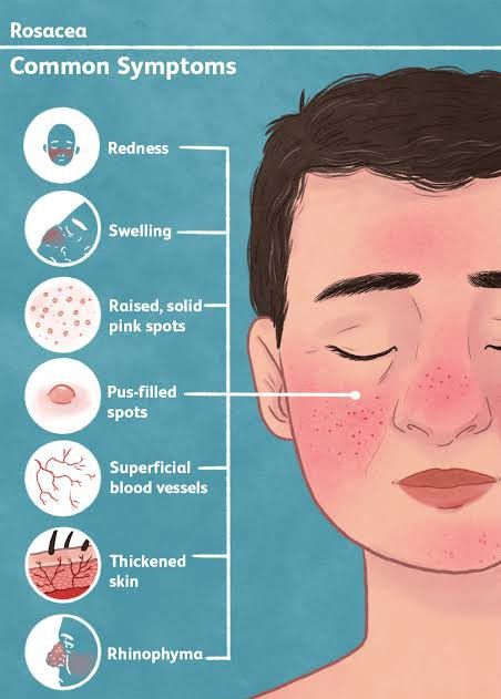 Rosacea - MEDizzy