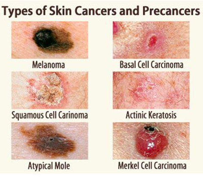 Skin cancer