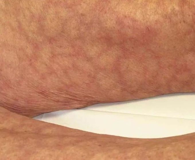 Skin rash