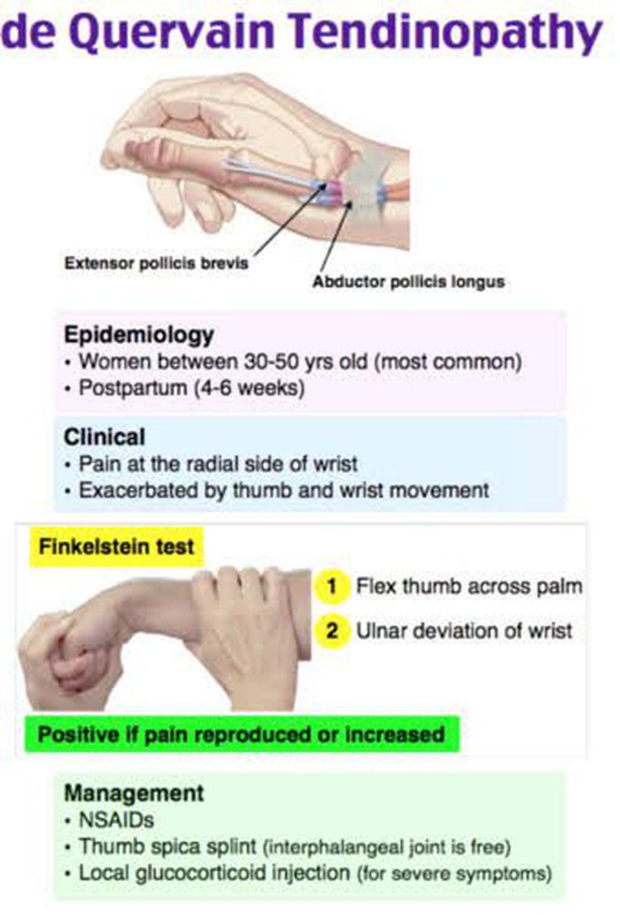 De Quervain Tendinopathy