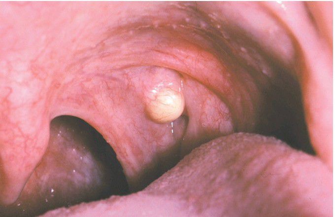 Oral lymphoepithelial cyst