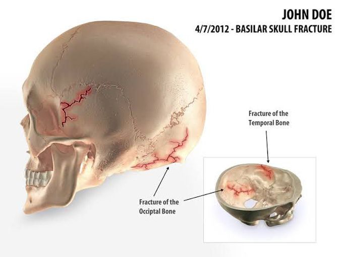 Basilar skull fracture