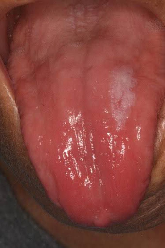 Cause of atrophic glossitis