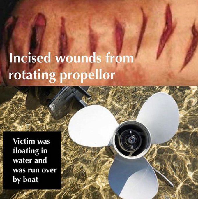 Propeller Injuries