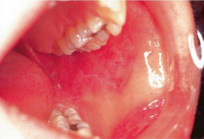 Lupus erythmatosus (oral manifestation)