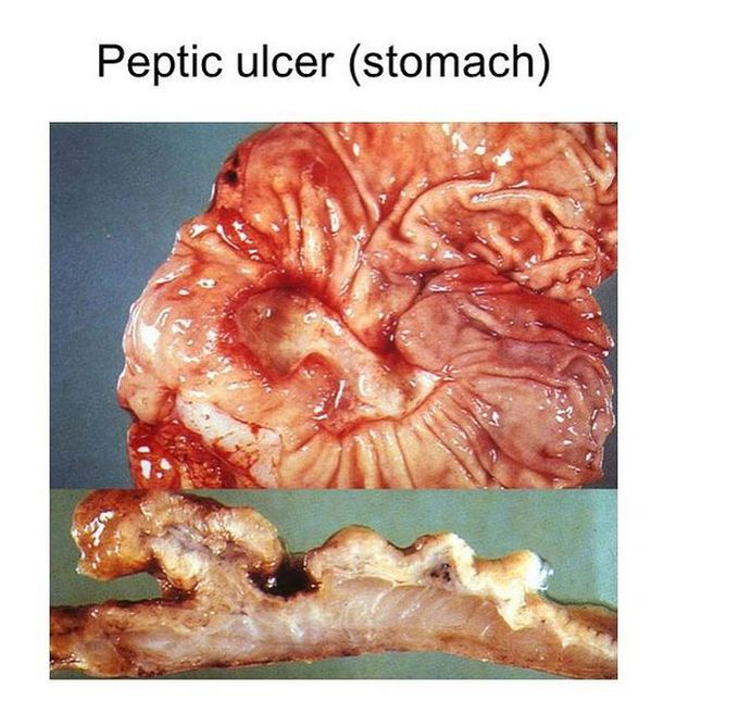 Peptic Ulcer of Stomach