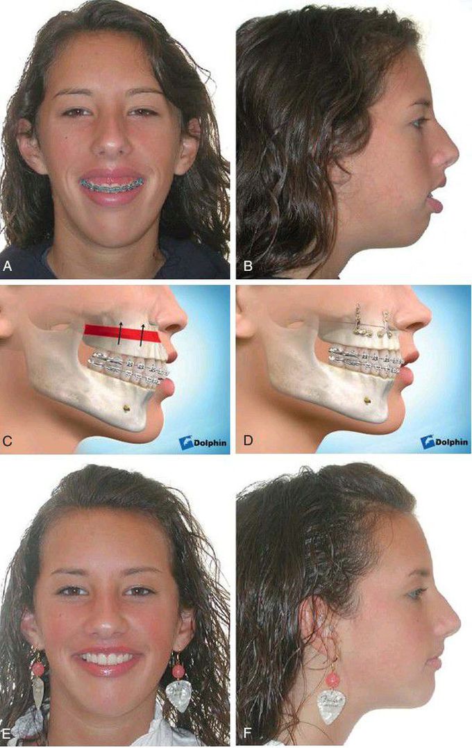Typical clinical features of vertical maxillary excess.