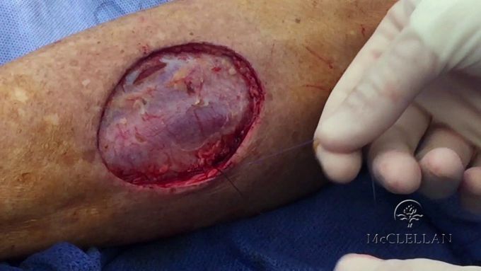 Split Thickness Skin Graft Reconstruction Pearl: The Cerclage Reduction