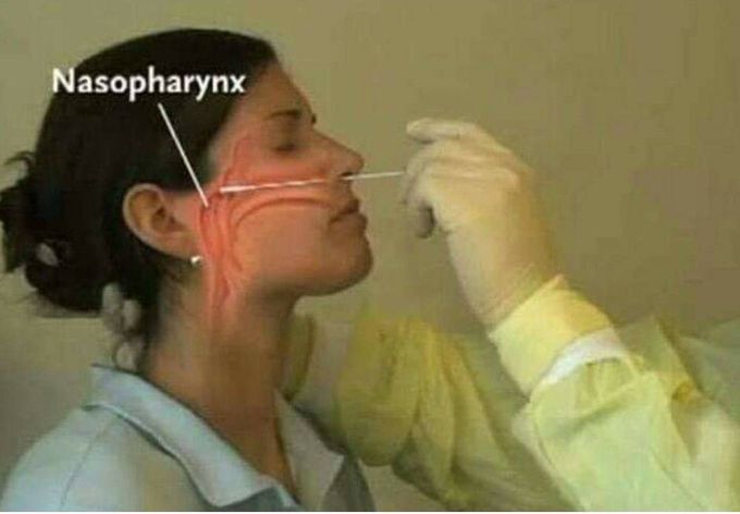 Nasopharynx swab sample collect for Covid-19
