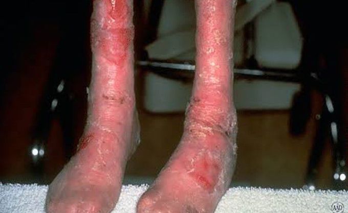 Epidermolysis bullosa