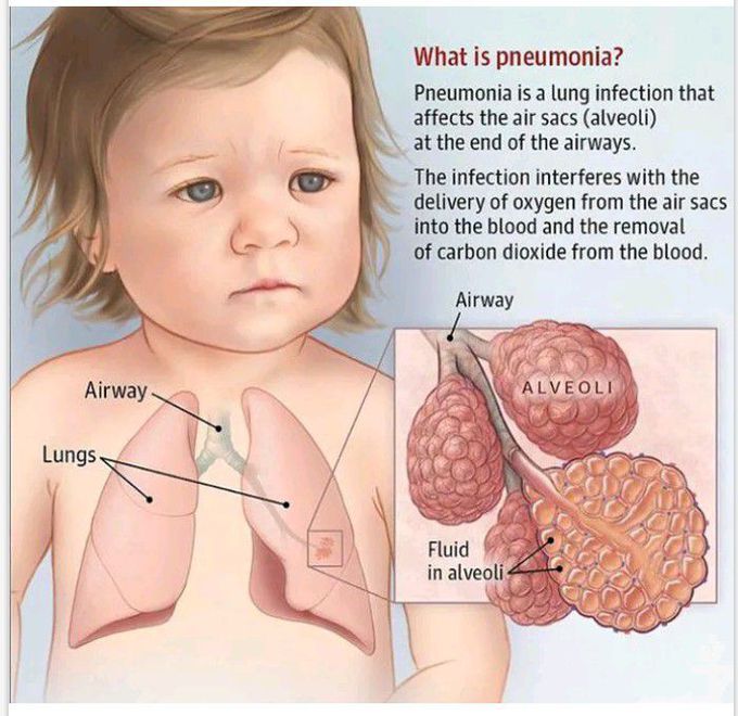 What is pneumonia?