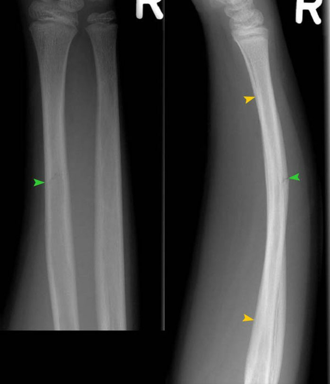 Pseudofracture