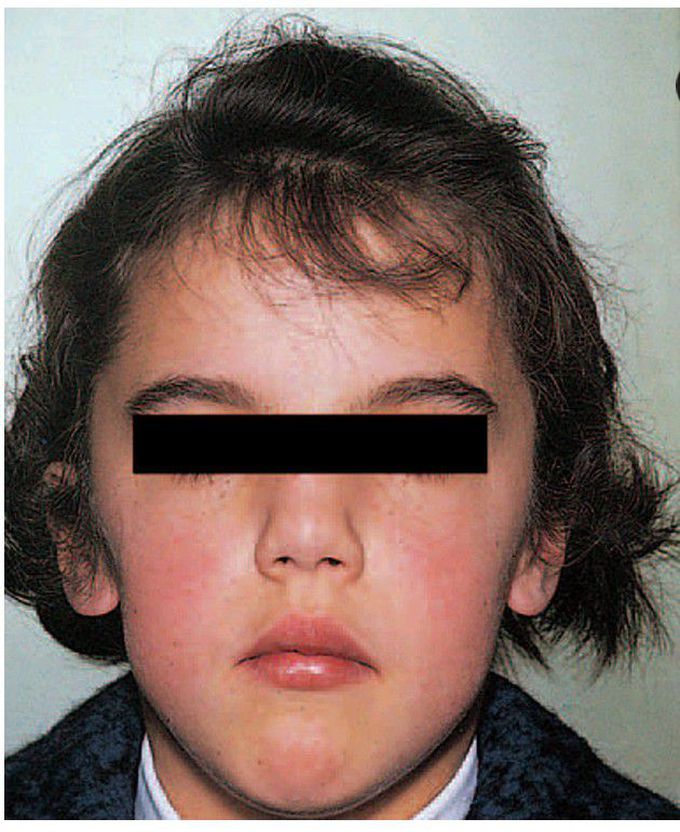 Gorlin's syndrome