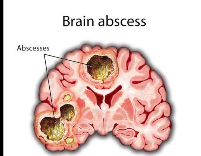 Symptoms of brain abscess
