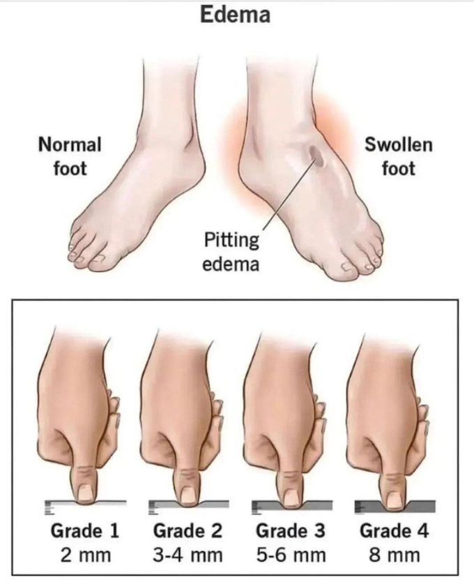 Grades of Edema