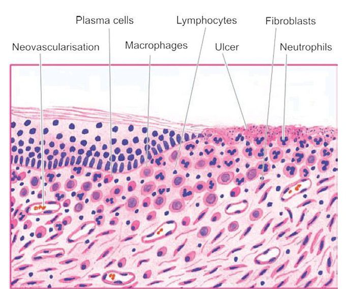 Granulation tissue