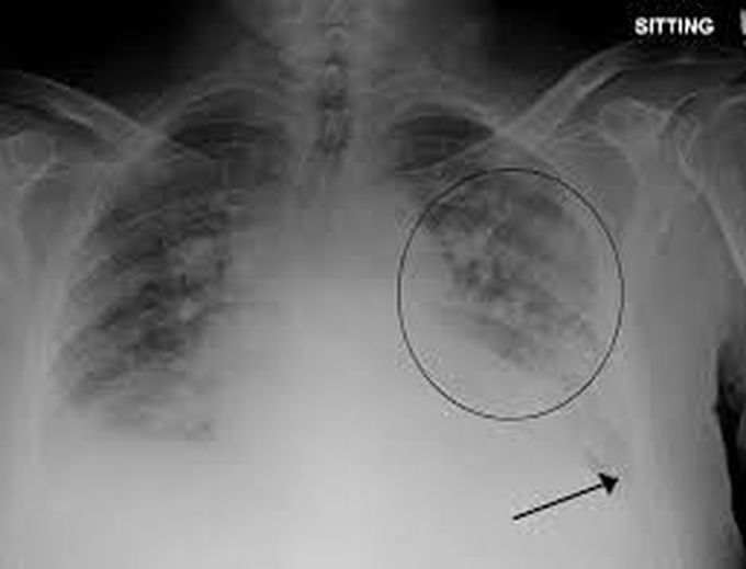 Treatment for pulmonary edema