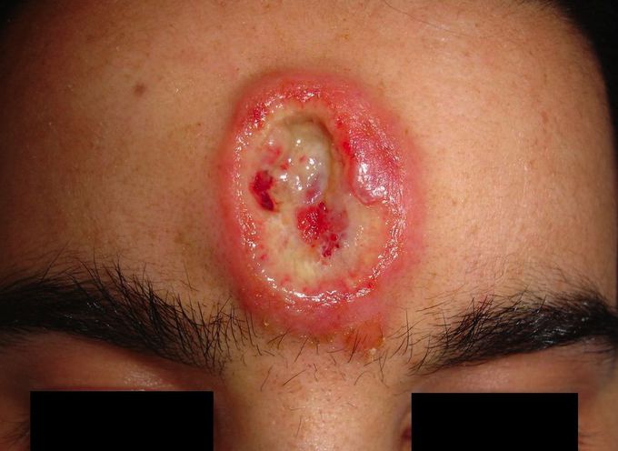 Which of the following microorganisms is present in the lesion(gumma)?