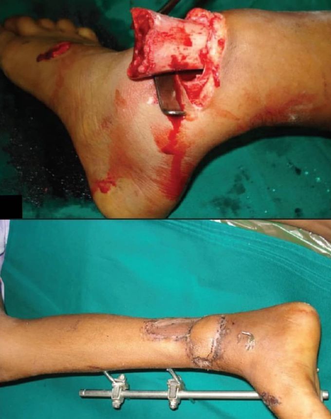 A patient with lower third leg open fracture with soft tissue loss, covered by gracilis free flap and the result at 5 weeks with complete healing of the wounds. 