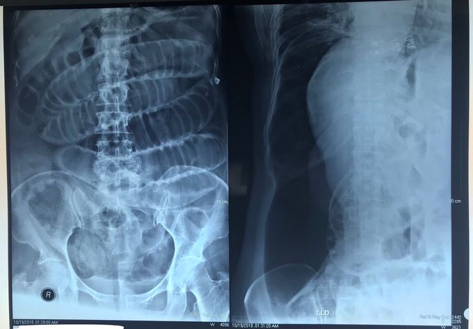 Abdominal X-ray