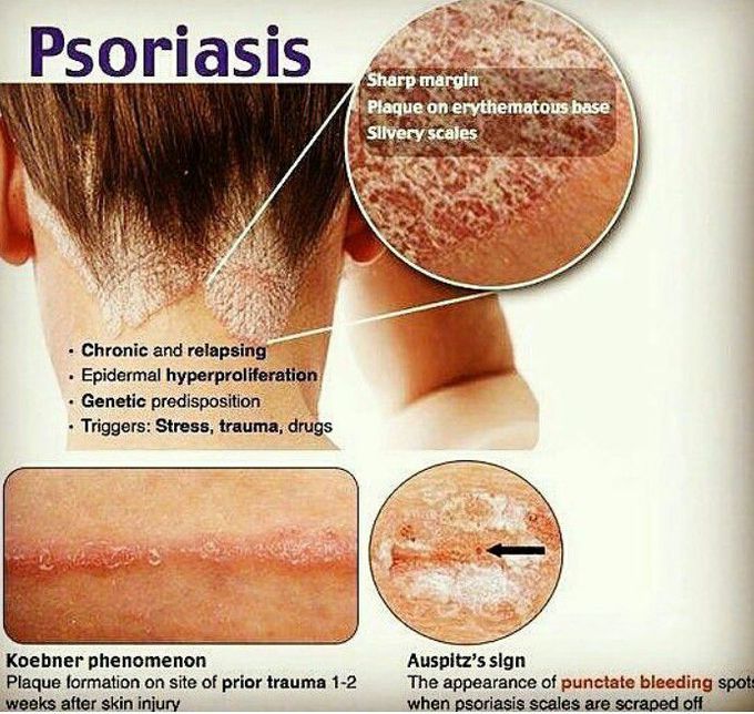Psoriasis