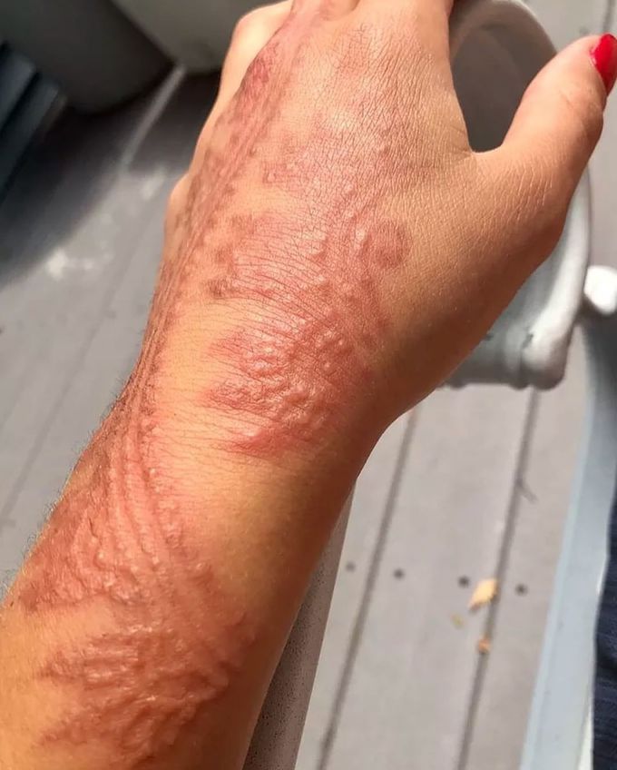 Allergic reaction to PPD in black henna tattoo