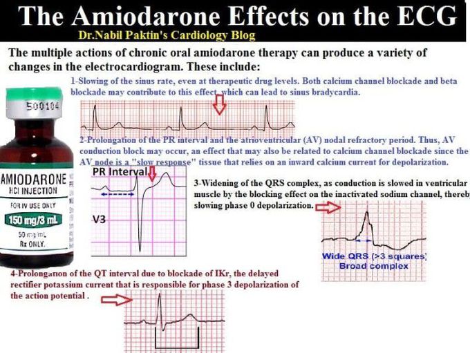 Effects of Amiodarone on ECG
