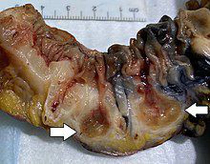 causes of diverticulitis