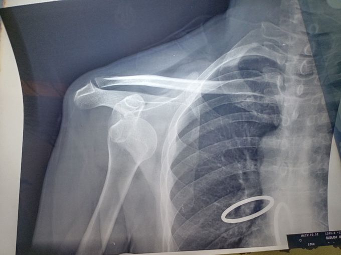 Shoulder dislocation