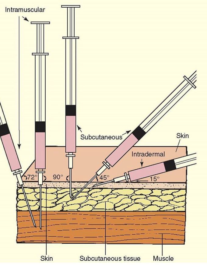 The Injection positions💉