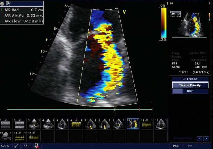 Mitral regurgitation jet on echo