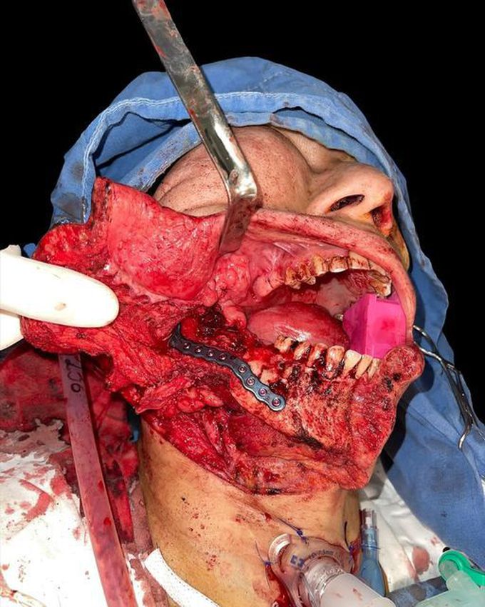 An Ongoing Maxillofacial Surgery