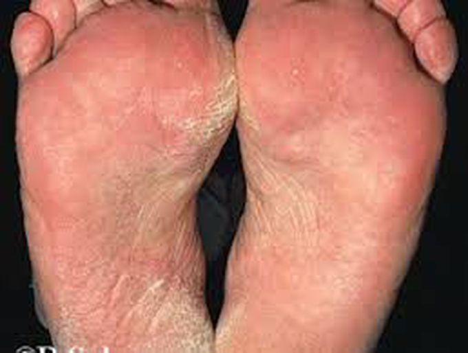 Tinea Pedis