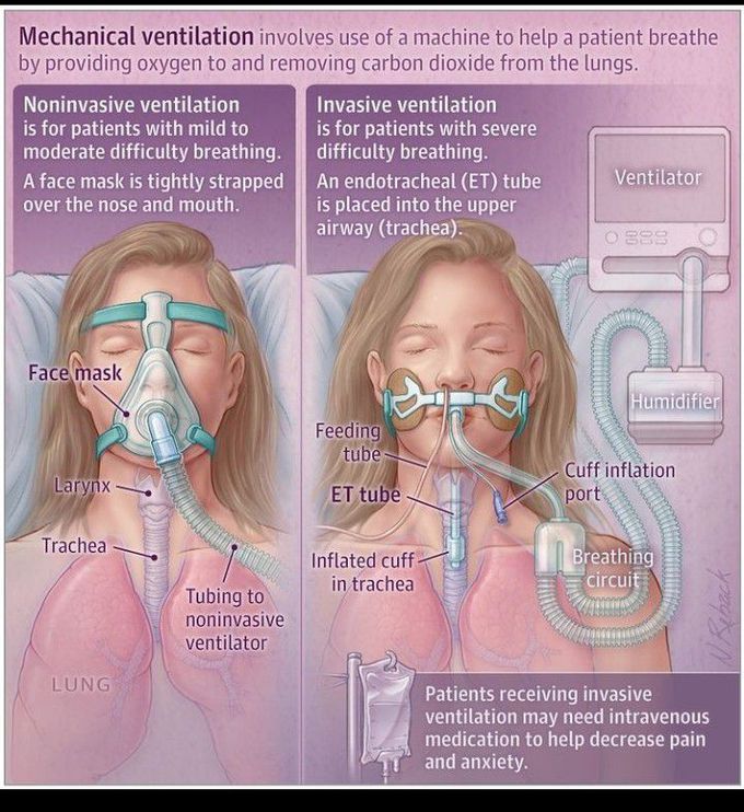 Mechanical ventilation