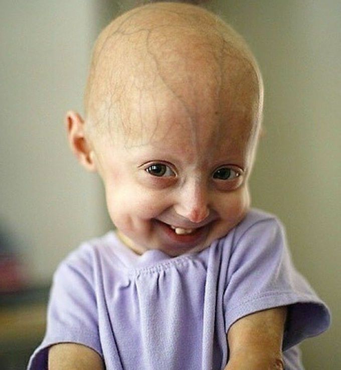 Hutchinson-Gilford Progeria Syndrome