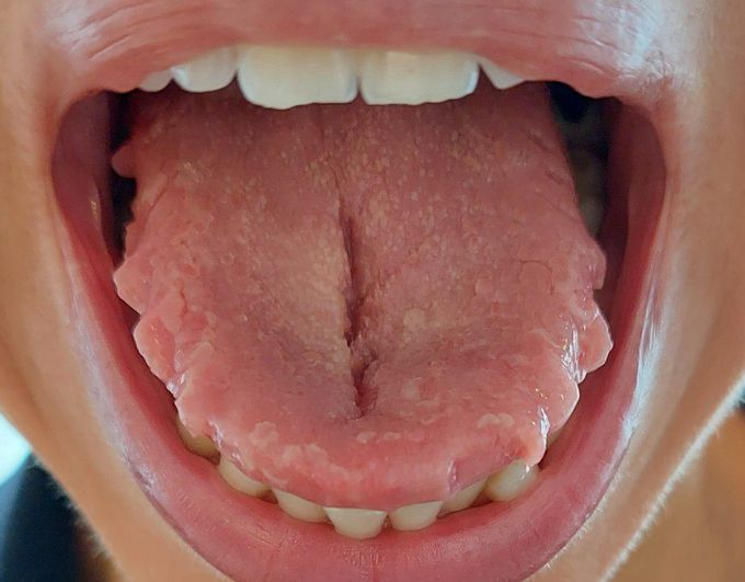 Glossitis with central fissure and scalopped tongue.