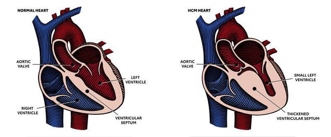 Hypertrophic Cardiomyopathy