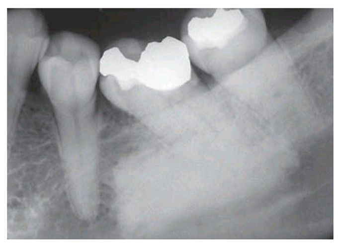 Sclerotic bone