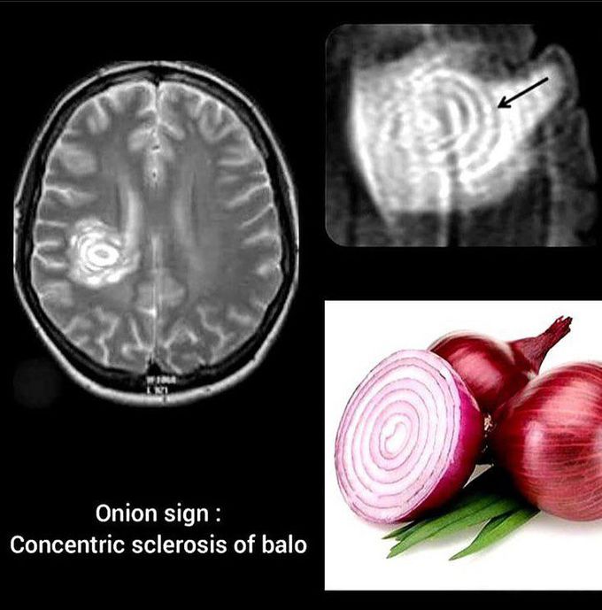 Baló Concentric Sclerosis