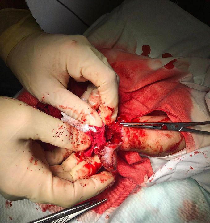 An accident from using an ax! The patients thumb is barely hanging on by its skin.